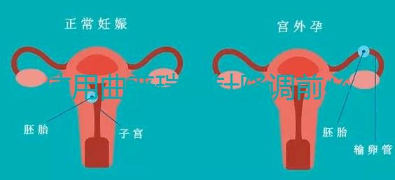 使用曲普瑞林針降調(diào)前必看：3大作用對(duì)比5大副作用