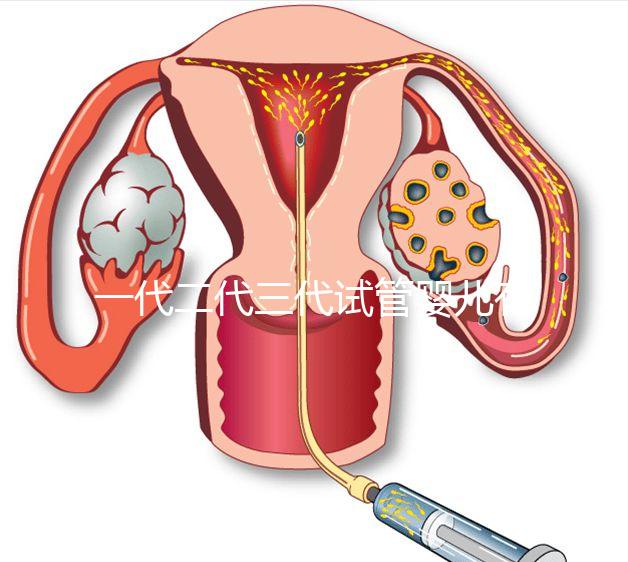 一代二代三代試管嬰兒有什么區別？