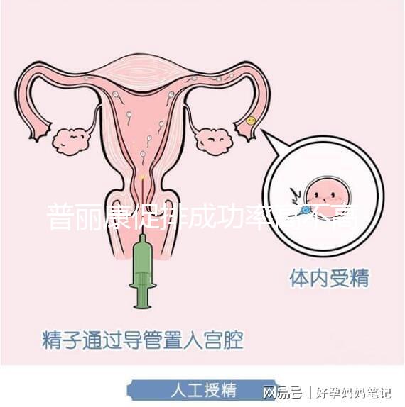 普麗康促排成功率高不高揭秘，能否取出卵泡的關鍵看…